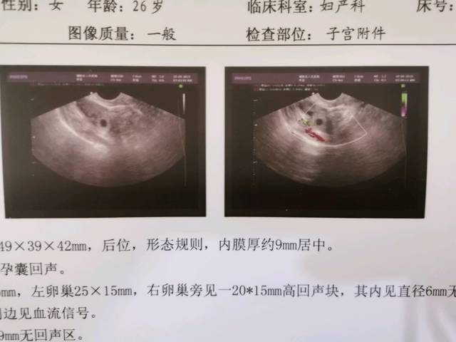 E试管-高龄国内试管胎停去安徽LRC代怀做双胞胎一次成功